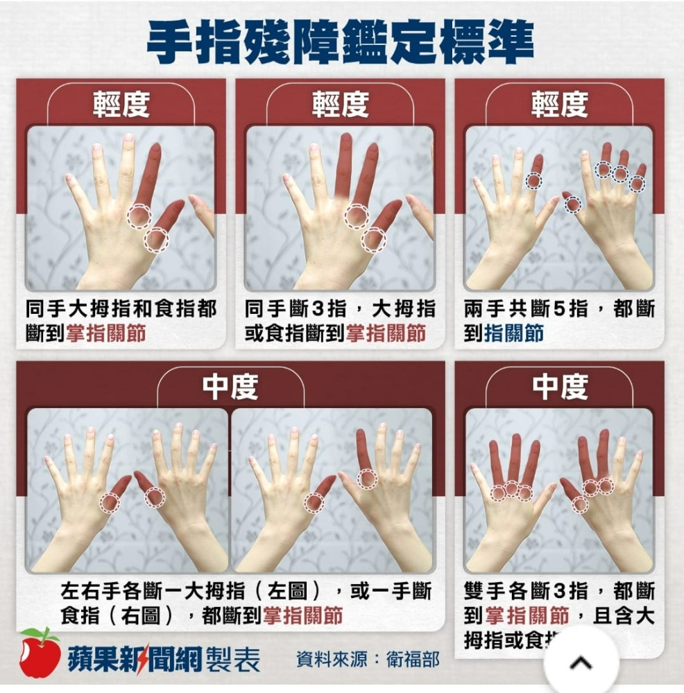 食指跟中指全斷卻無法申請殘障手冊,她無奈:法令上我算正常人,但在現實生活中我不是 | 爆料公社